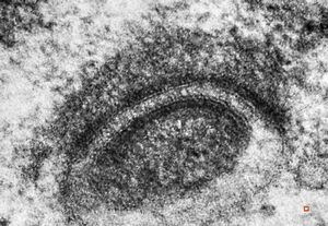 M,12y. | intracytoplasmic desmosome - pineal germinoma